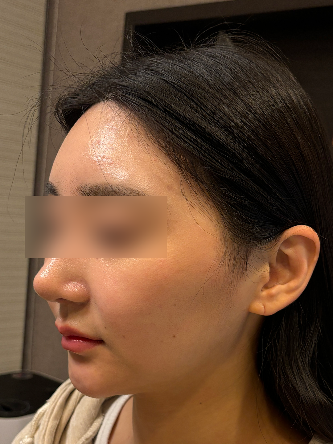 시술 전