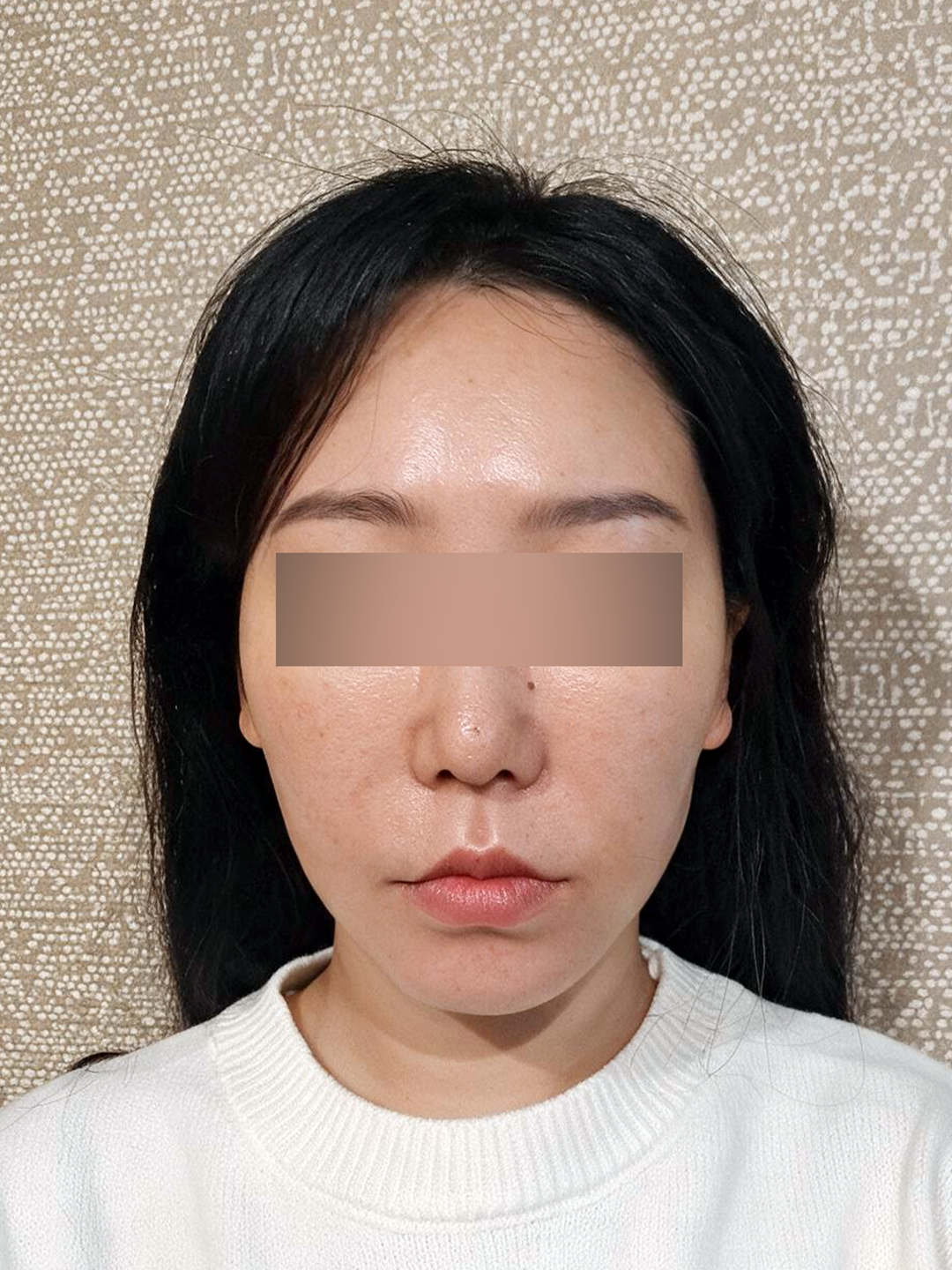 시술 전