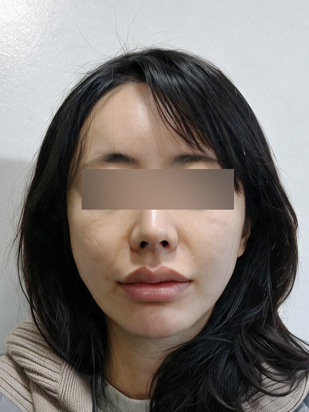 시술 전