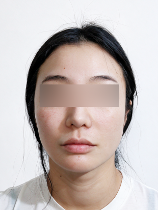 치료 전 이미지