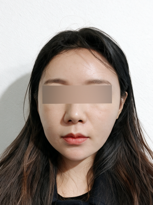 치료 전 이미지