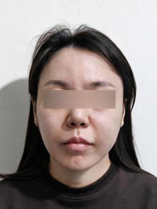 치료 전 이미지